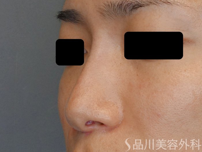 症例NO.71151のAFTER写真