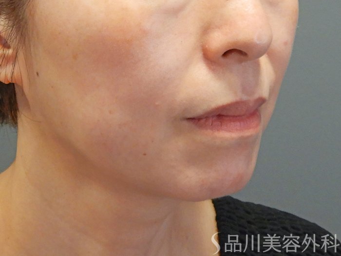 症例NO.72002のAFTER写真