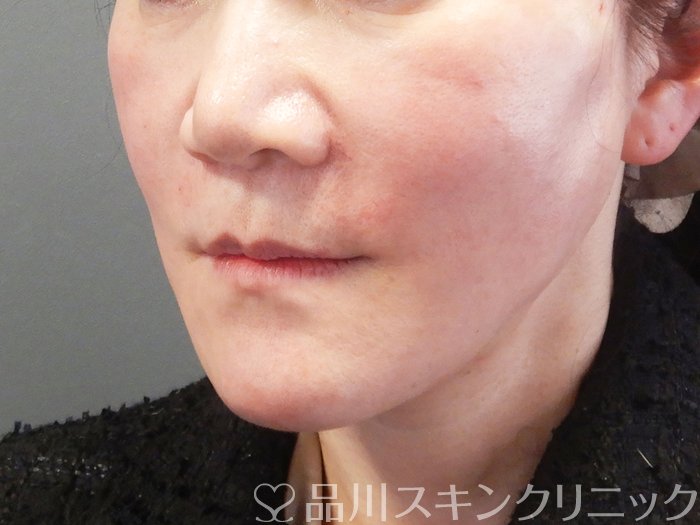 症例NO.73576のAFTER写真