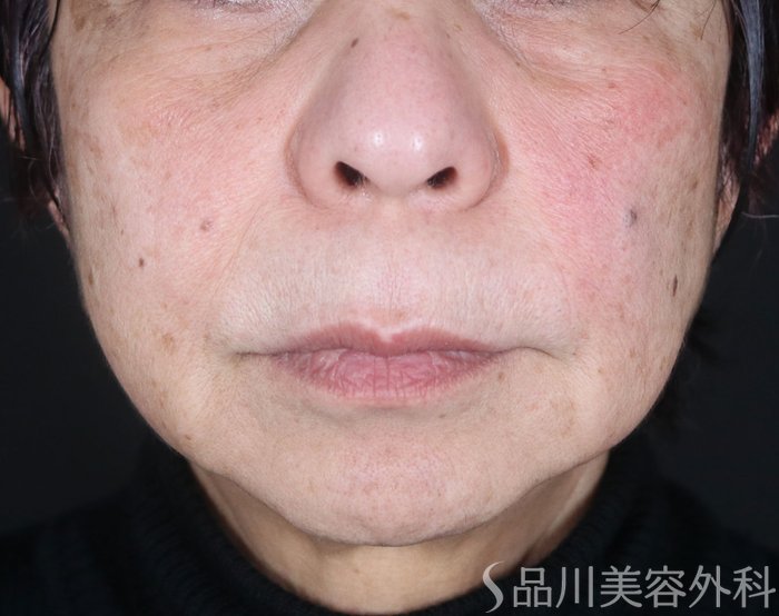 症例NO.72944のBEFORE写真