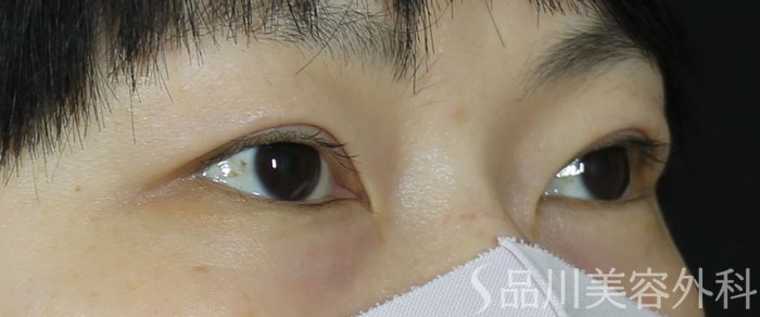 症例NO.70594のAFTER写真