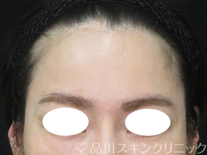 症例NO.70435のAFTER写真
