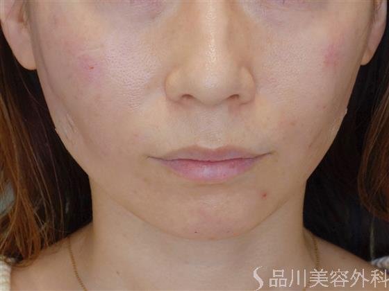 症例NO.51123のAFTER写真