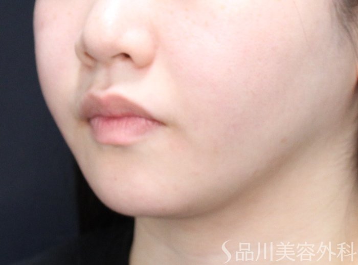 症例NO.70961のAFTER写真
