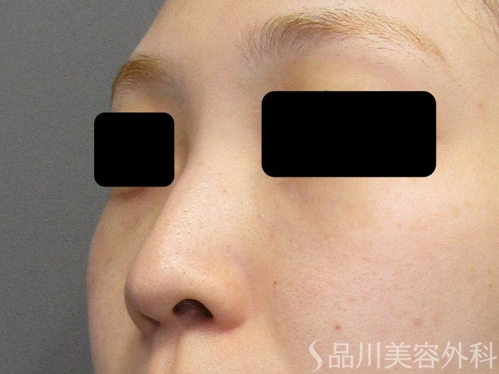症例NO.75153のBEFORE写真