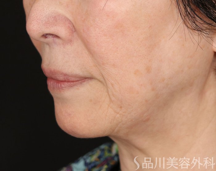 症例NO.71862のBEFORE写真