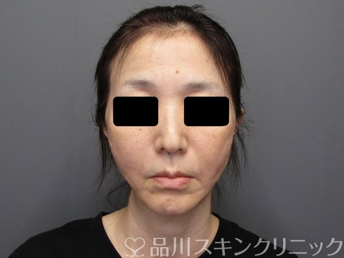 症例NO.74934のAFTER写真