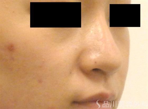 症例NO.49999のAFTER写真