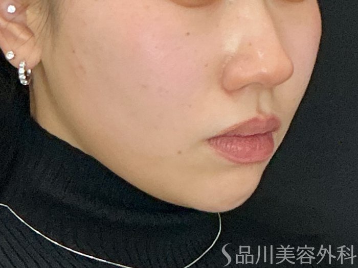 症例NO.72916のAFTER写真