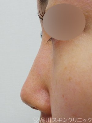 症例NO.67042のBEFORE写真