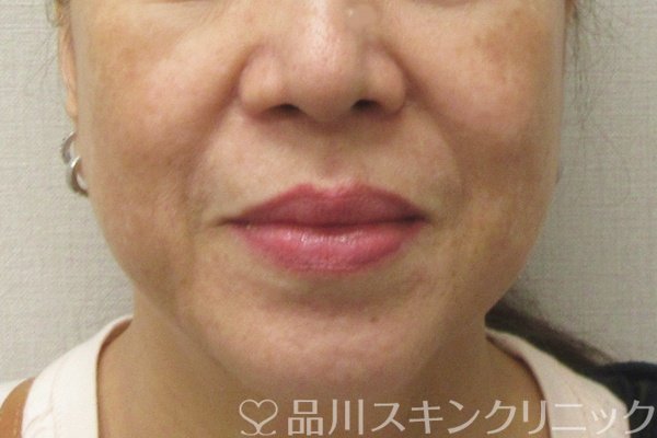 症例NO.75224のBEFORE写真