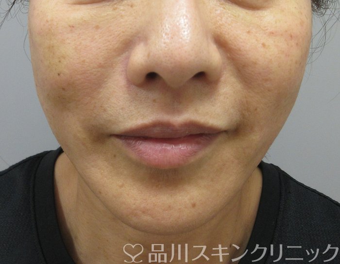 症例NO.74307のAFTER写真