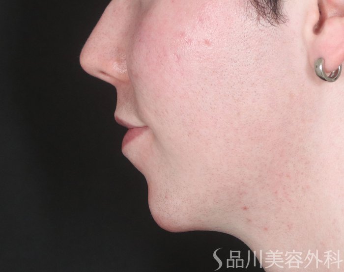 症例NO.72905のAFTER写真