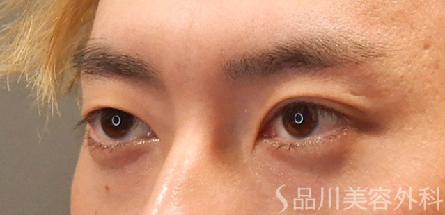 症例NO.72590のBEFORE写真