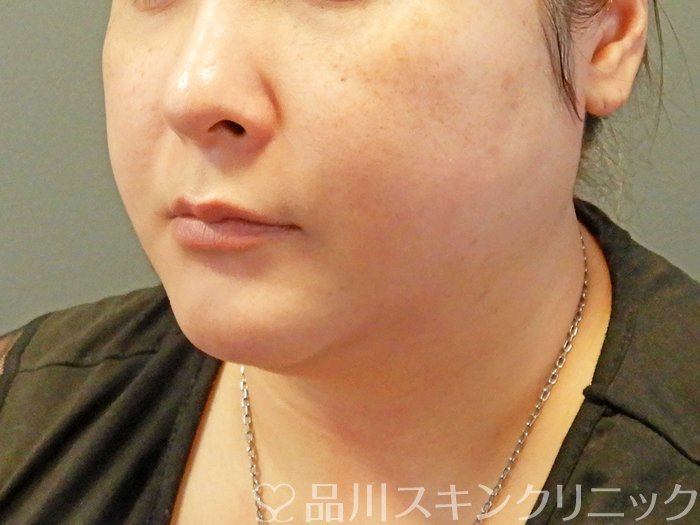 症例NO.67477のBEFORE写真