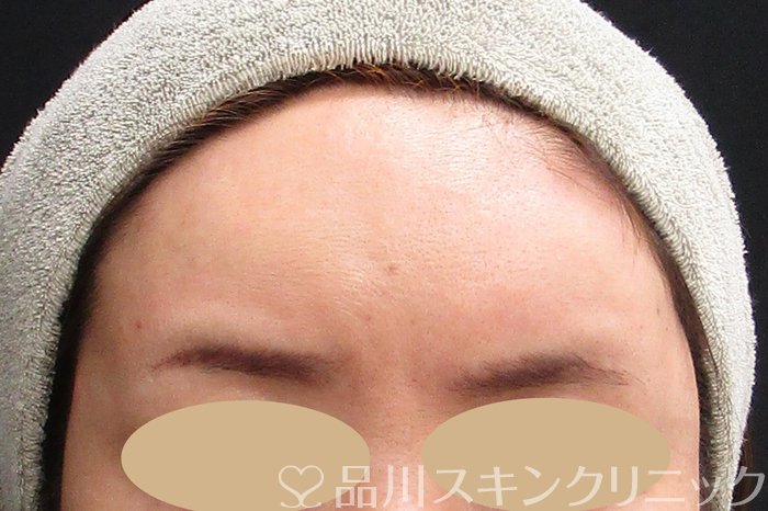 症例NO.74720のAFTER写真