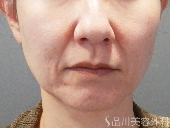 症例NO.73937のBEFORE写真