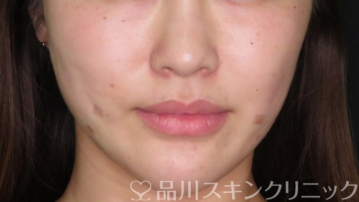 症例NO.71011のAFTER写真
