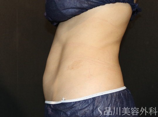 症例NO.74918のAFTER写真