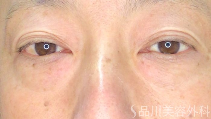 症例NO.71845のBEFORE写真