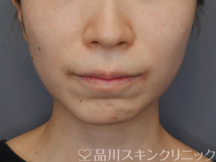 症例NO.72826のBEFORE写真