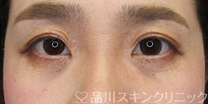 症例NO.75173のBEFORE写真