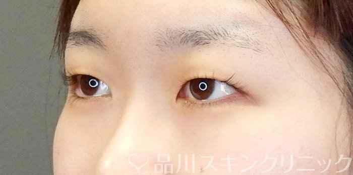 症例NO.63670のBEFORE写真
