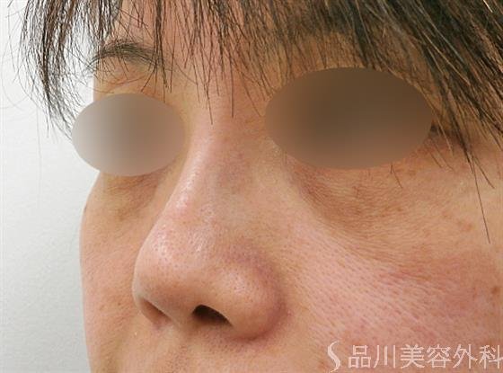 症例NO.25034のAFTER写真