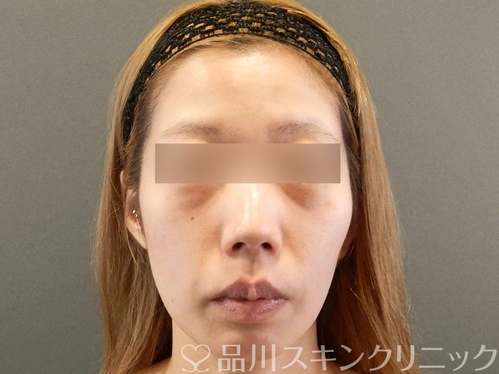 症例NO.65753のBEFORE写真
