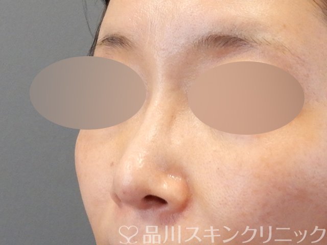 症例NO.67536のAFTER写真