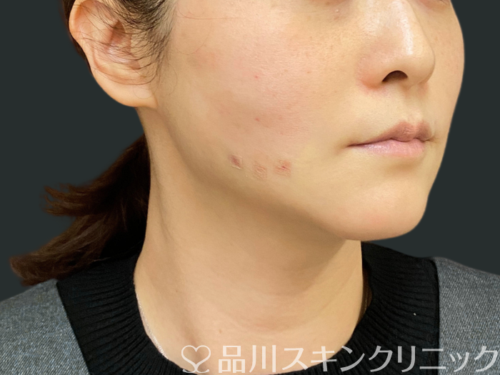 症例NO.74300のAFTER写真