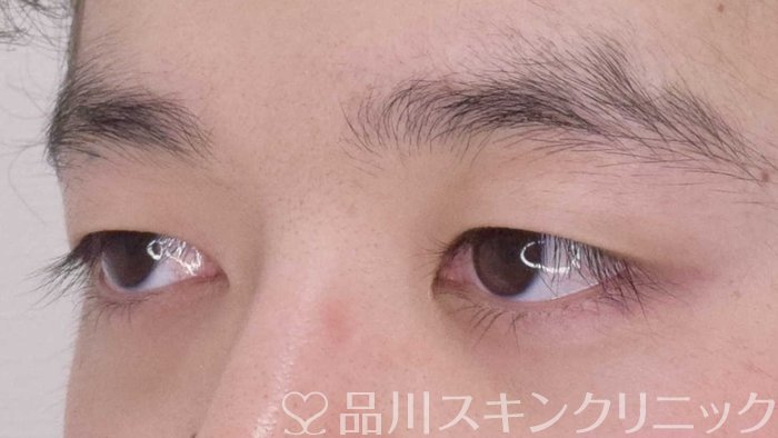 症例NO.64807のBEFORE写真