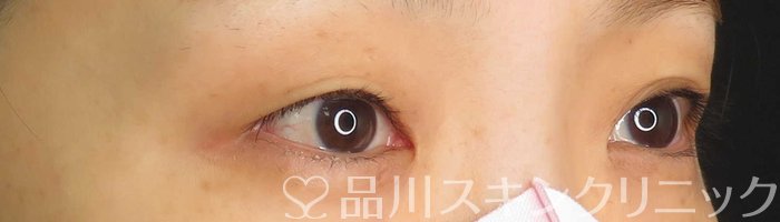 症例NO.66243のBEFORE写真