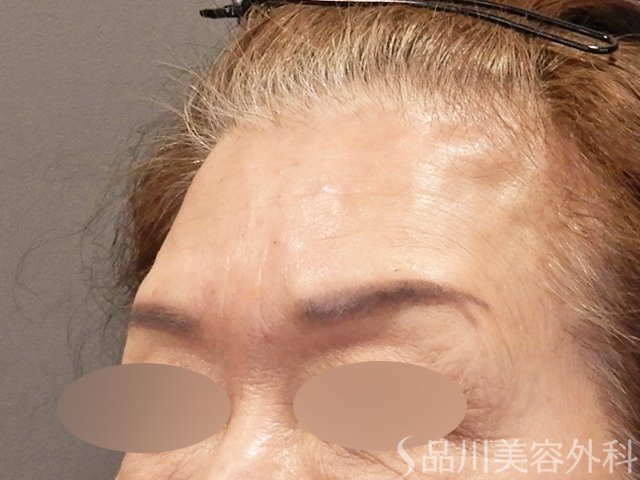 症例NO.72717のAFTER写真