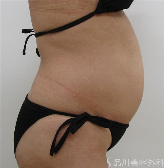 症例NO.43682のAFTER写真