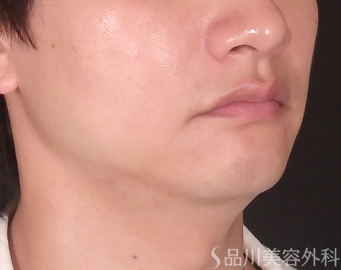 症例NO.71070のBEFORE写真