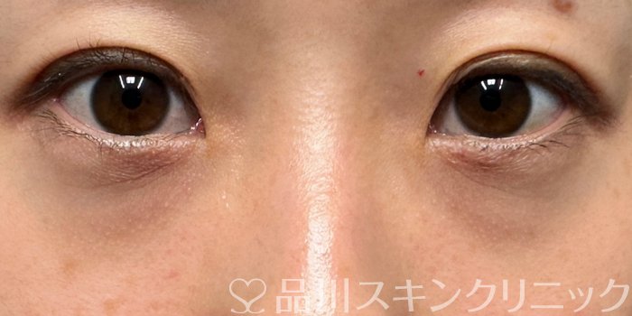 症例NO.68030のBEFORE写真