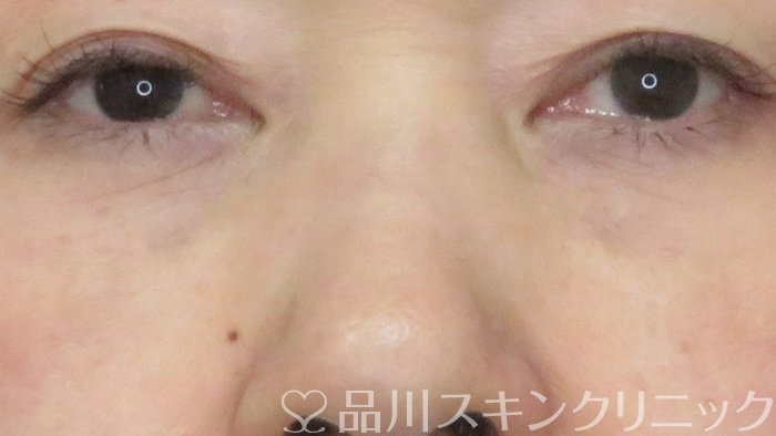 症例NO.71899のAFTER写真