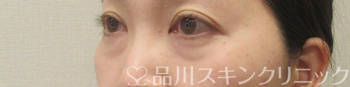 症例NO.69585のBEFORE写真