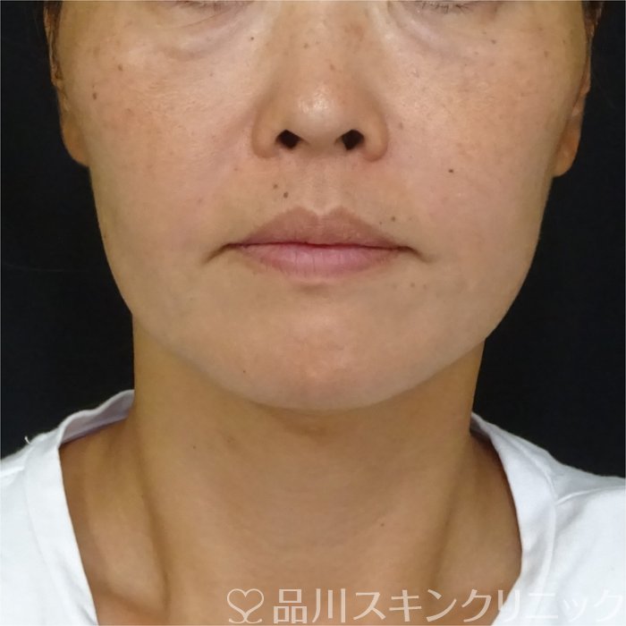 症例NO.71656のAFTER写真