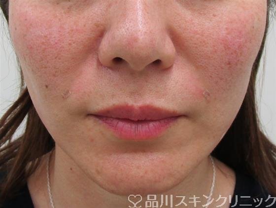 症例NO.34060のAFTER写真