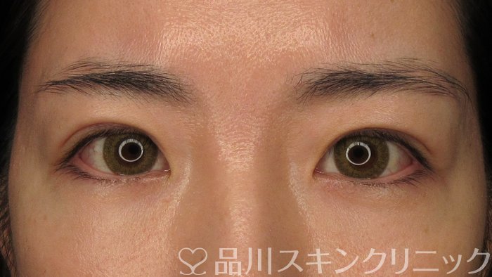 症例NO.71768のAFTER写真