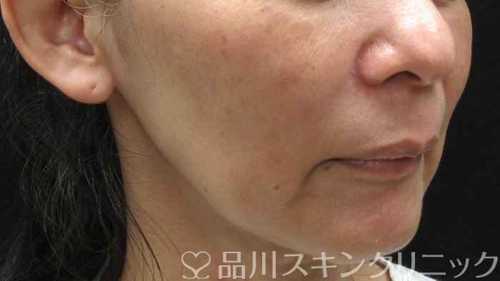 症例NO.69767のBEFORE写真
