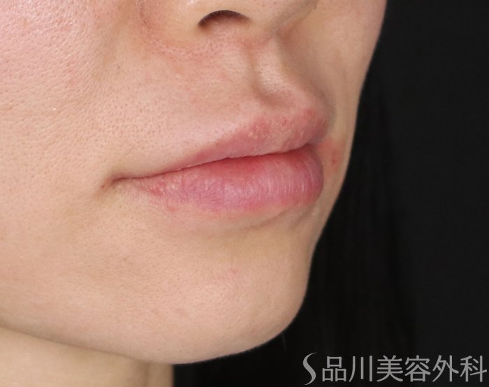 症例NO.73756のAFTER写真