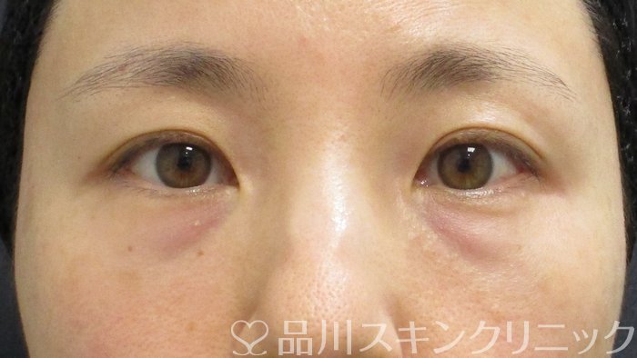 症例NO.65143のBEFORE写真