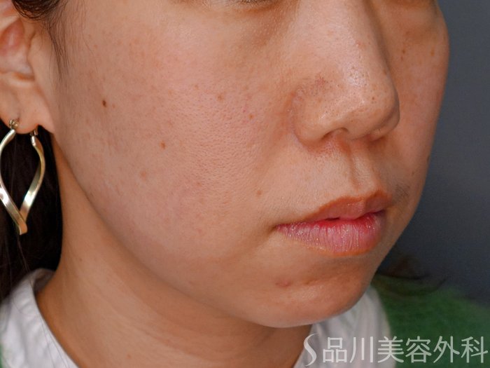 症例NO.73793のBEFORE写真