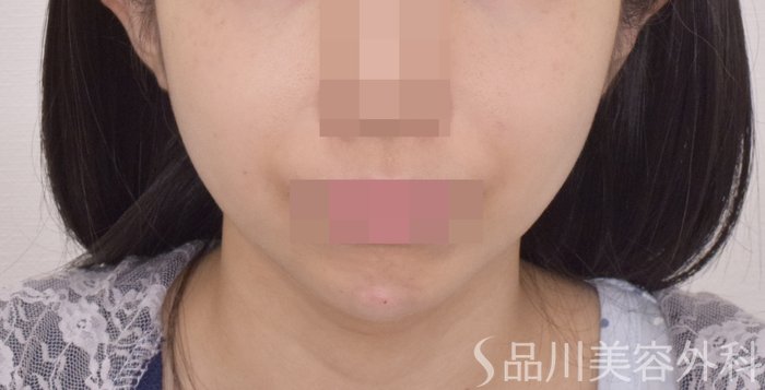 症例NO.64667のAFTER写真