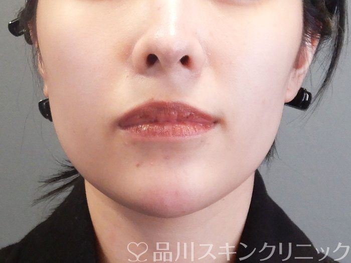 症例NO.72980のAFTER写真