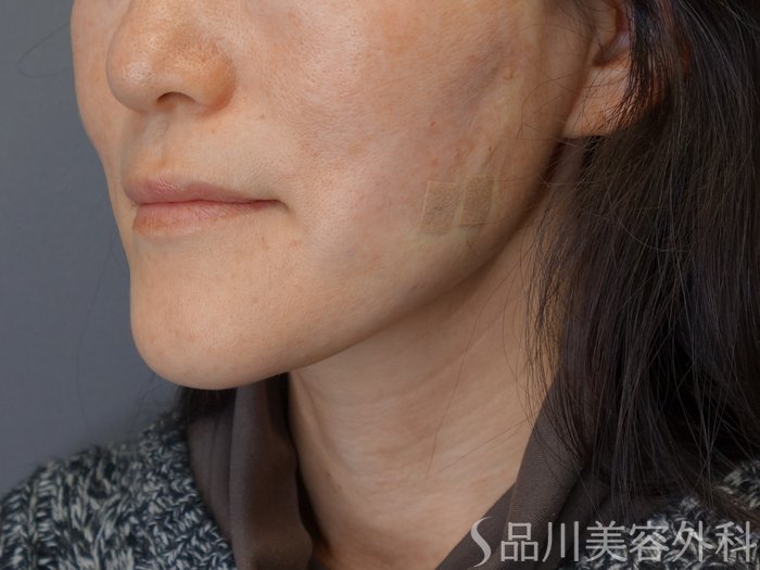 症例NO.72865のAFTER写真