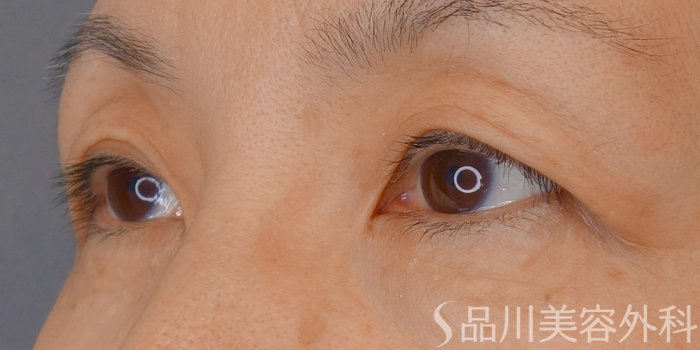 症例NO.72495のBEFORE写真